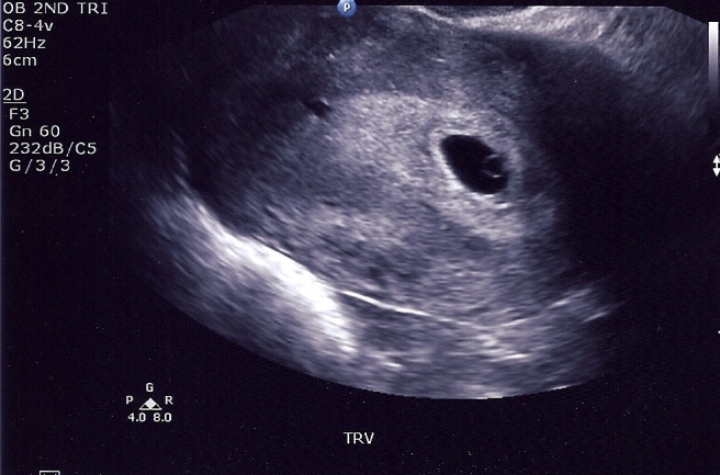 6 Week ultrasound scan