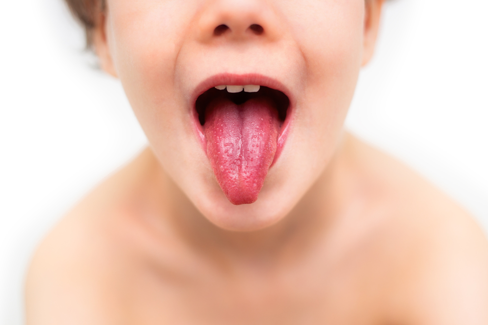 šarlah, simptomi šarlaha, osip kod šarlaha, kako se liječi šarlah, malinasti jezik