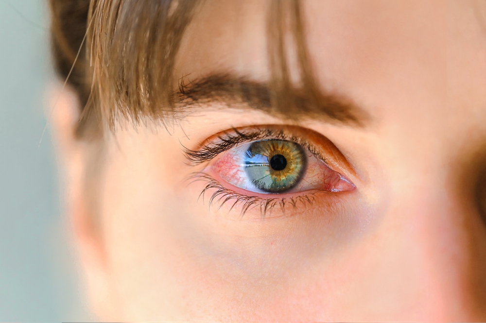 Konjuktivitis: Kako se lijei i za koliko dana prolazi? | Telegram.hr