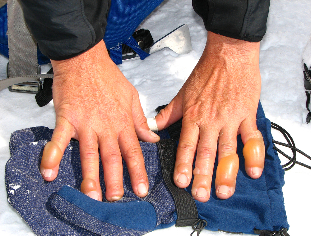 ozebline smrzavanje na hladnoći smrznute ruke