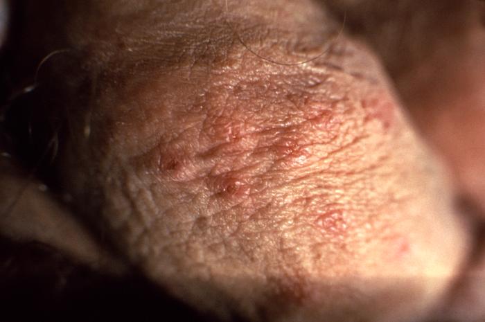 Genitalni herpes: Metode kojima moete ublaiti simptome infekcije |  Telegram.hr
