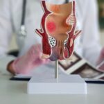 Većina analnih fistula nastaje kao posljedica infekcije. Ako se ne liječi, može dovesti do ponavljanih apcesa