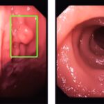 Polip na debelom crijevu: Pet stvari koje treba znati