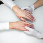 Kineski znanstvenici otkrili fizički put kojim stres uzrokuje pogoršanje ekcema