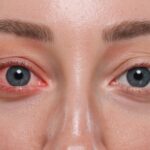 Sva lica konjunktivitisa: kako razlikovati infekciju od alergije