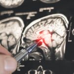 Većina moždanih udara može se spriječiti: sedam ključnih koraka prevencije