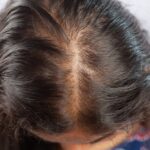 Lijek za reumatoidni artritis potiče rast kose kod ljudi koji imaju alopeciju, puno bolje od drugih tretmana