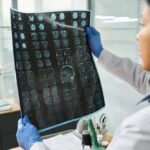 Novi model umjetne inteligencije mogao bi pomoći u otkrivanju genetskog rizika od moždanog udara