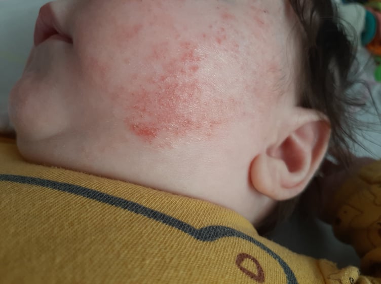 Mama Jelena: Moj Lukas ima atopijski dermatitis od treeg mjeseca ivota,  smeta mu i esto plae | Super1.hr